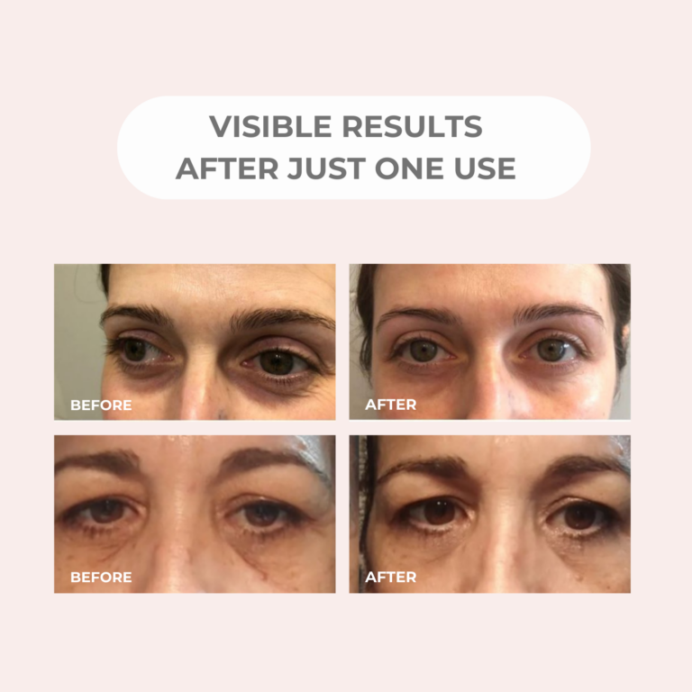 BEAUTICAL Microneedle Eye Patches-before after