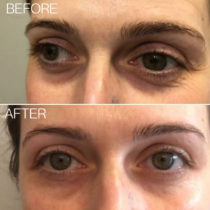 beautical skincare microneedle eye patches anti wrinkle before after